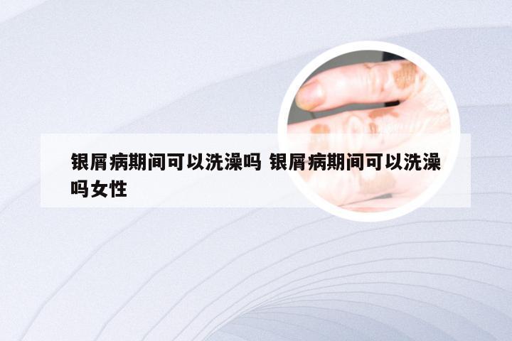 银屑病期间可以洗澡吗 银屑病期间可以洗澡吗女性