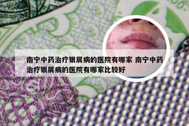 南宁中药治疗银屑病的医院有哪家 南宁中药治疗银屑病的医院有哪家比较好