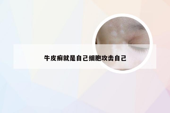 牛皮癣就是自己细胞攻击自己