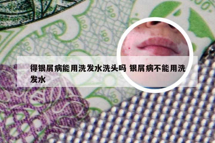 得银屑病能用洗发水洗头吗 银屑病不能用洗发水