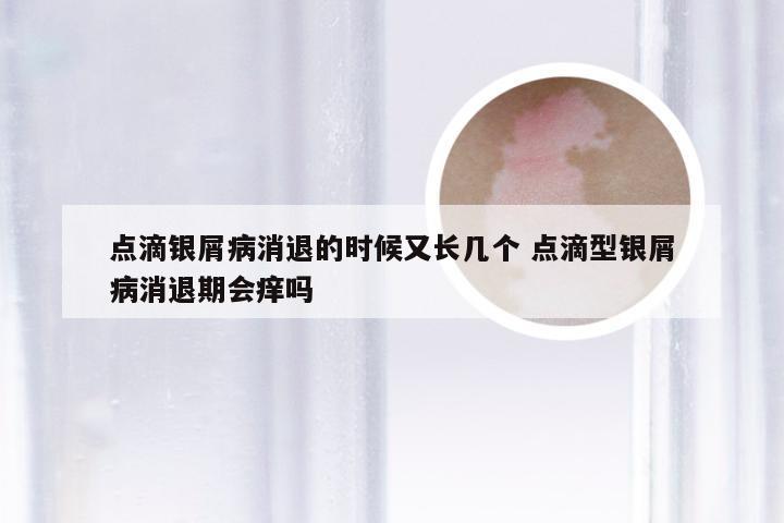 点滴银屑病消退的时候又长几个 点滴型银屑病消退期会痒吗