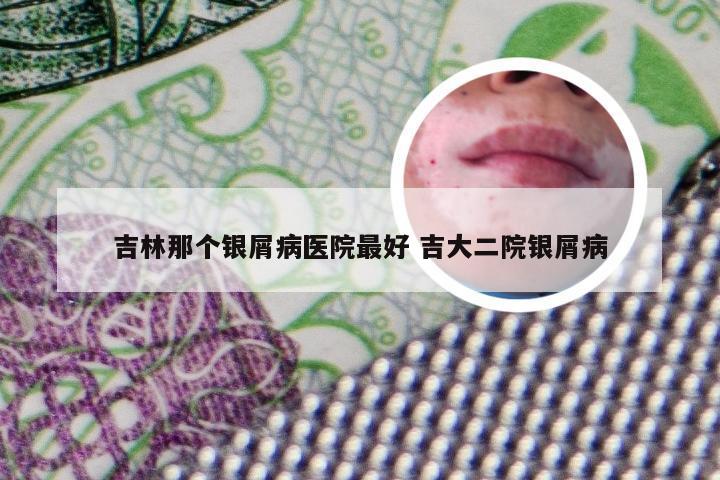 吉林那个银屑病医院最好 吉大二院银屑病