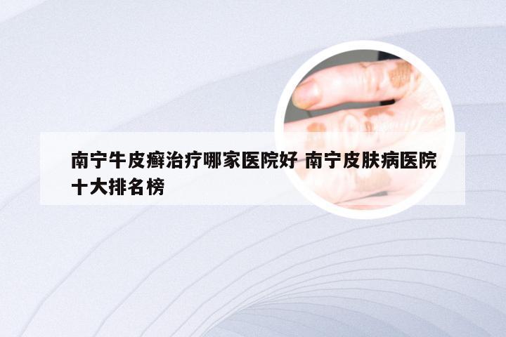 南宁牛皮癣治疗哪家医院好 南宁皮肤病医院十大排名榜