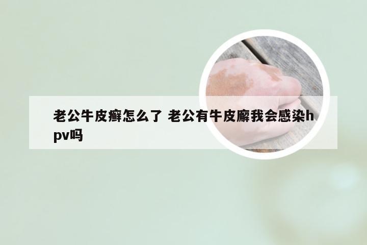 老公牛皮癣怎么了 老公有牛皮廨我会感染hpv吗