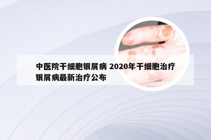 中医院干细胞银屑病 2020年干细胞治疗银屑病最新治疗公布