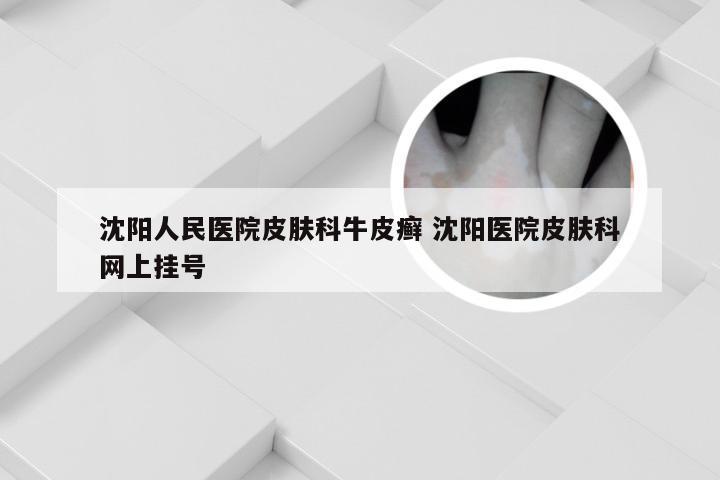 沈阳人民医院皮肤科牛皮癣 沈阳医院皮肤科网上挂号