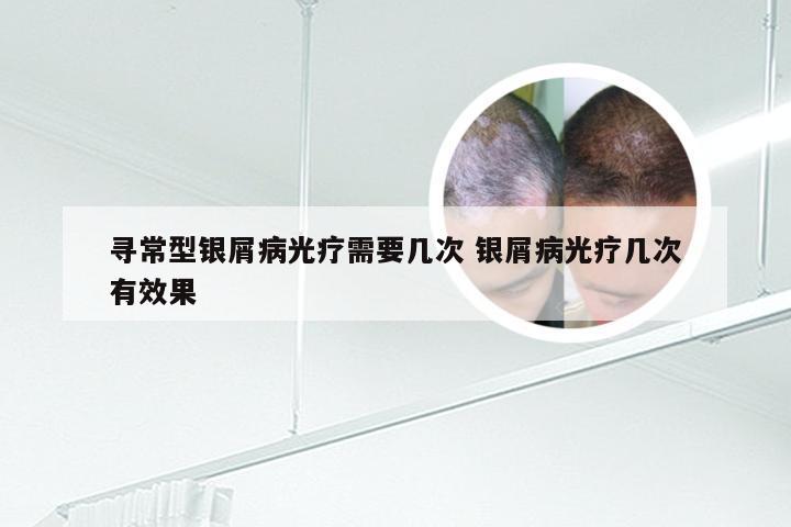 寻常型银屑病光疗需要几次 银屑病光疗几次有效果