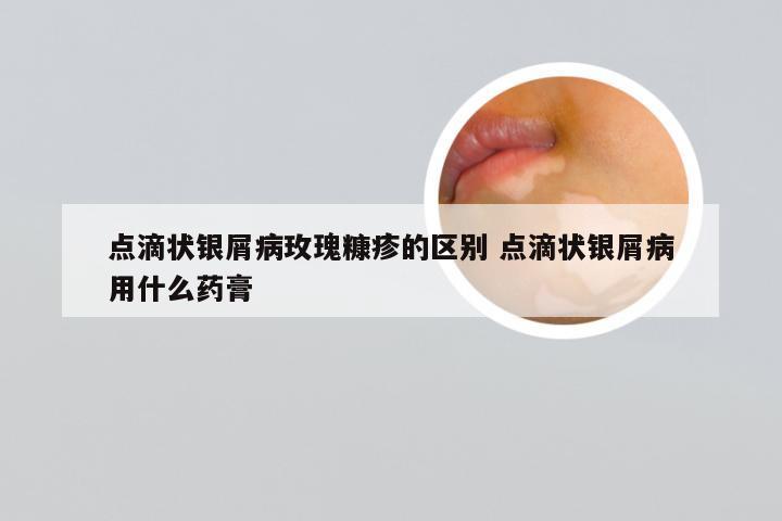 点滴状银屑病玫瑰糠疹的区别 点滴状银屑病用什么药膏