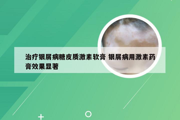 治疗银屑病糖皮质激素软膏 银屑病用激素药膏效果显著