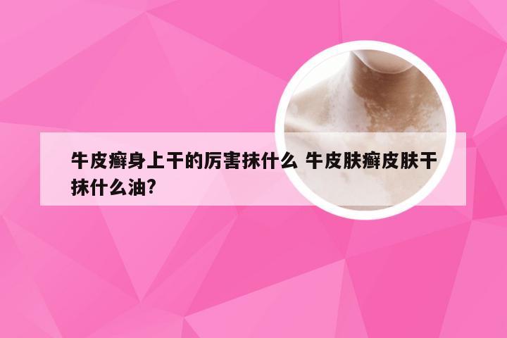 牛皮癣身上干的厉害抹什么 牛皮肤癣皮肤干抹什么油?