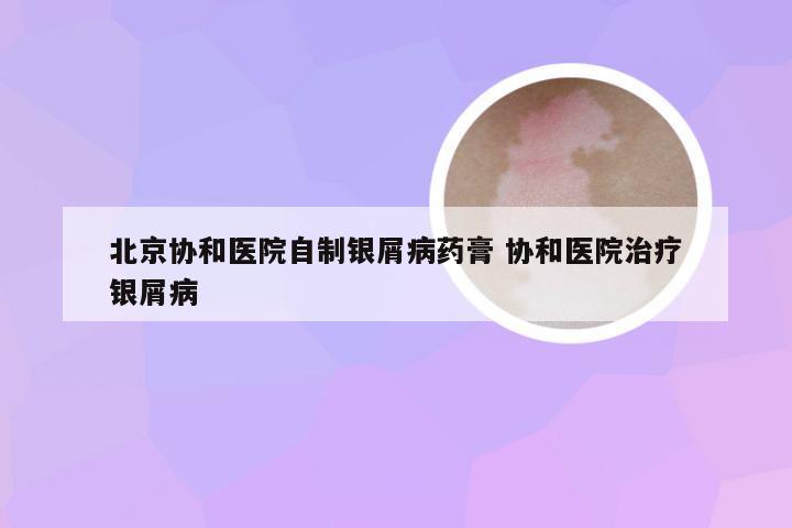 北京协和医院自制银屑病药膏 协和医院治疗银屑病