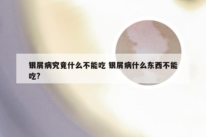 银屑病究竟什么不能吃 银屑病什么东西不能吃?