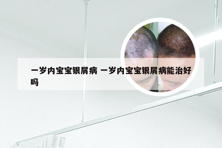 一岁内宝宝银屑病 一岁内宝宝银屑病能治好吗