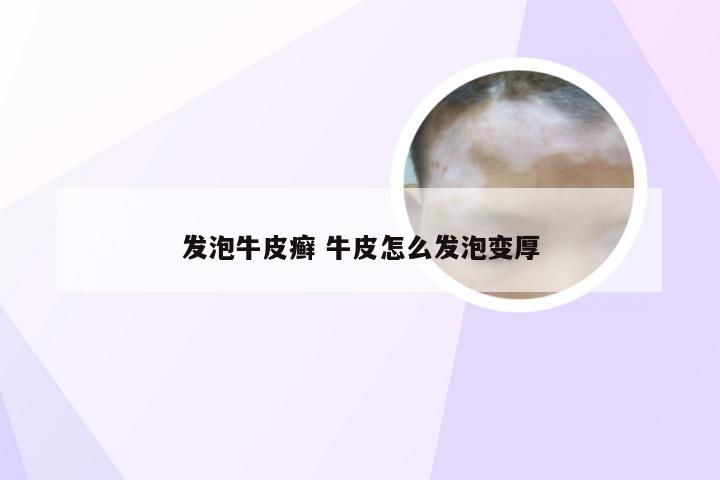 发泡牛皮癣 牛皮怎么发泡变厚