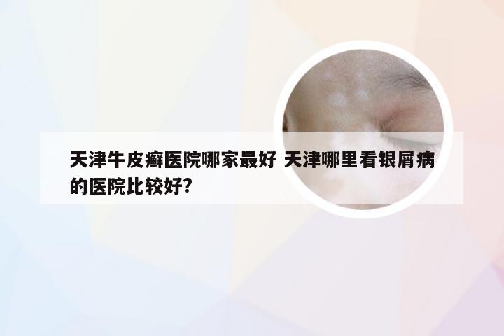 天津牛皮癣医院哪家最好 天津哪里看银屑病的医院比较好?