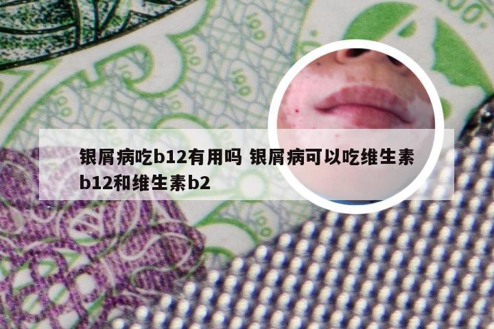 银屑病吃b12有用吗 银屑病可以吃维生素b12和维生素b2