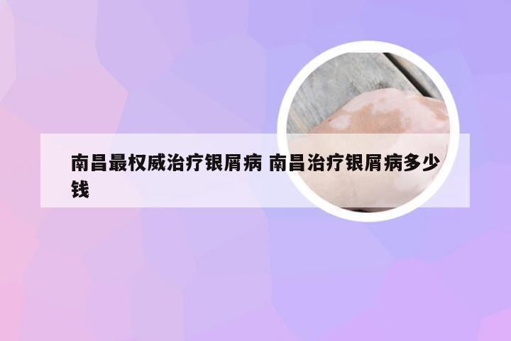 南昌最权威治疗银屑病 南昌治疗银屑病多少钱