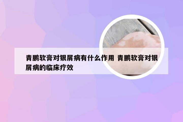 青鹏软膏对银屑病有什么作用 青鹏软膏对银屑病的临床疗效