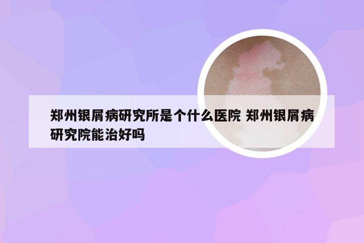 郑州银屑病研究所是个什么医院 郑州银屑病研究院能治好吗