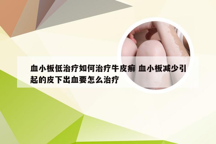 血小板低治疗如何治疗牛皮癣 血小板减少引起的皮下出血要怎么治疗