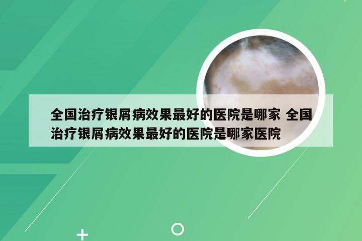 全国治疗银屑病效果最好的医院是哪家 全国治疗银屑病效果最好的医院是哪家医院