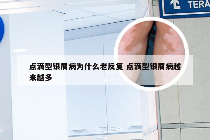 点滴型银屑病为什么老反复 点滴型银屑病越来越多