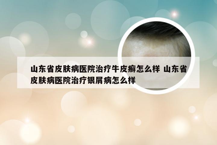 山东省皮肤病医院治疗牛皮癣怎么样 山东省皮肤病医院治疗银屑病怎么样