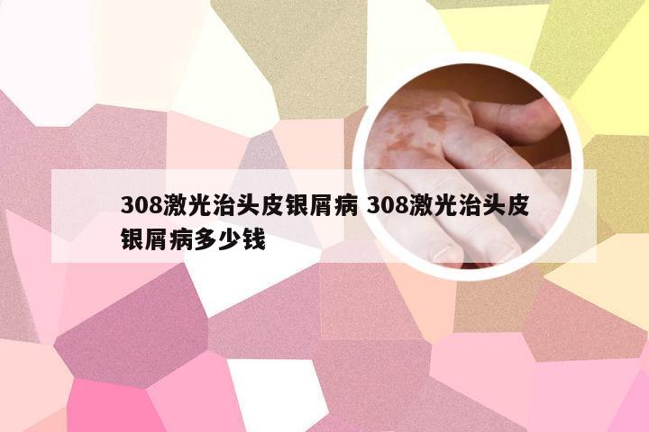 308激光治头皮银屑病 308激光治头皮银屑病多少钱