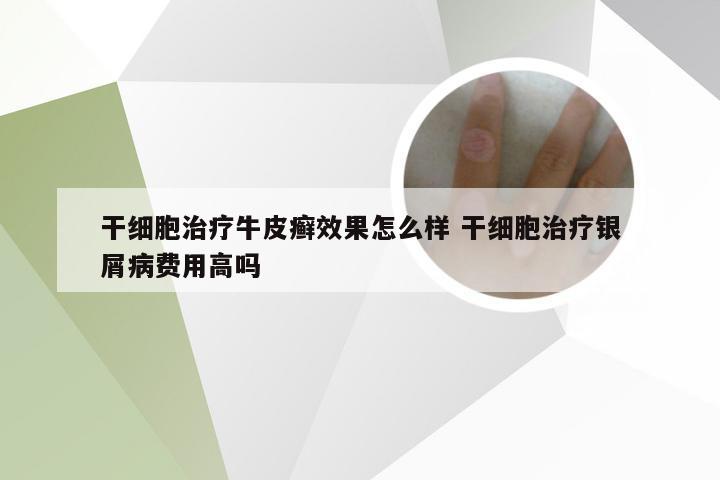 干细胞治疗牛皮癣效果怎么样 干细胞治疗银屑病费用高吗