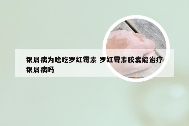 银屑病为啥吃罗红霉素 罗红霉素胶囊能治疗银屑病吗