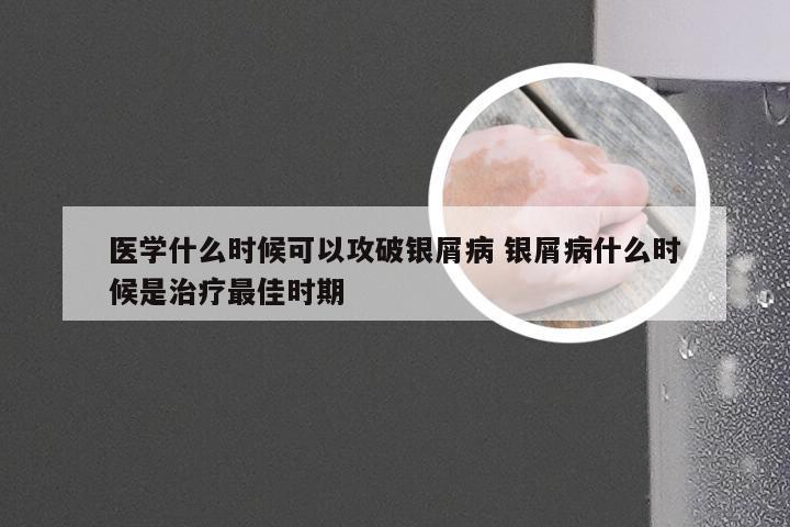 医学什么时候可以攻破银屑病 银屑病什么时候是治疗最佳时期