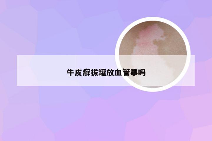 牛皮癣拔罐放血管事吗