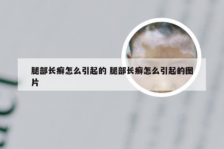 腿部长癣怎么引起的 腿部长癣怎么引起的图片