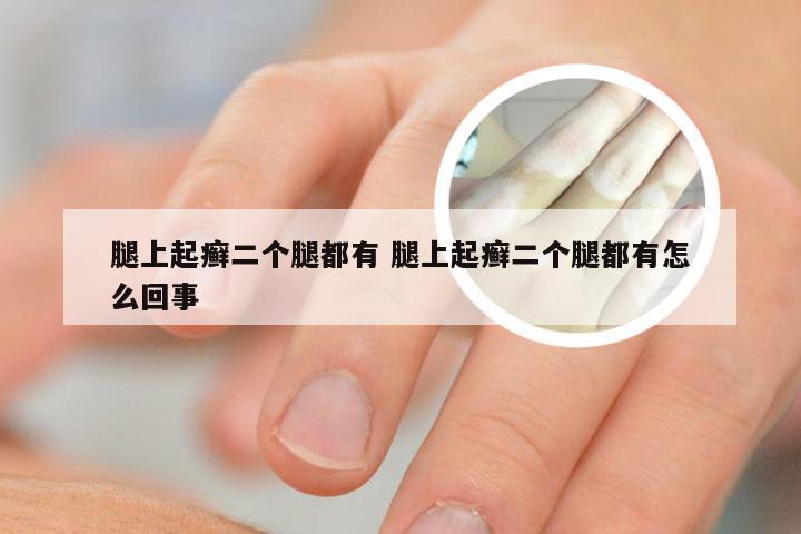 腿上起癣二个腿都有 腿上起癣二个腿都有怎么回事