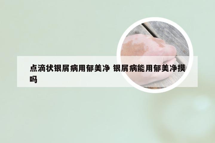 点滴状银屑病用郁美净 银屑病能用郁美净摸吗