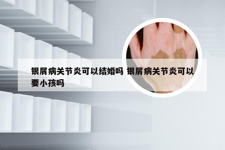 银屑病关节炎可以结婚吗 银屑病关节炎可以要小孩吗