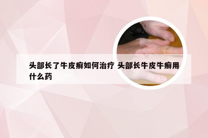 头部长了牛皮癣如何治疗 头部长牛皮牛癣用什么药