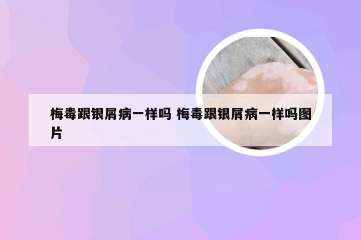 梅毒跟银屑病一样吗 梅毒跟银屑病一样吗图片