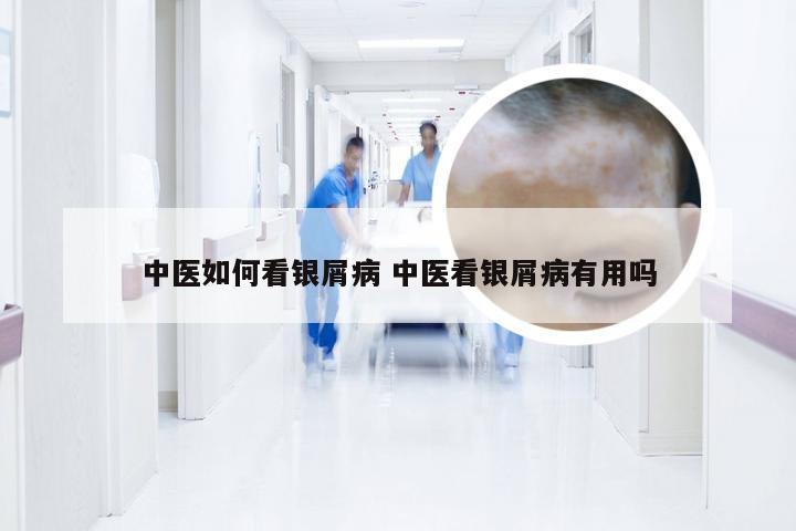 中医如何看银屑病 中医看银屑病有用吗