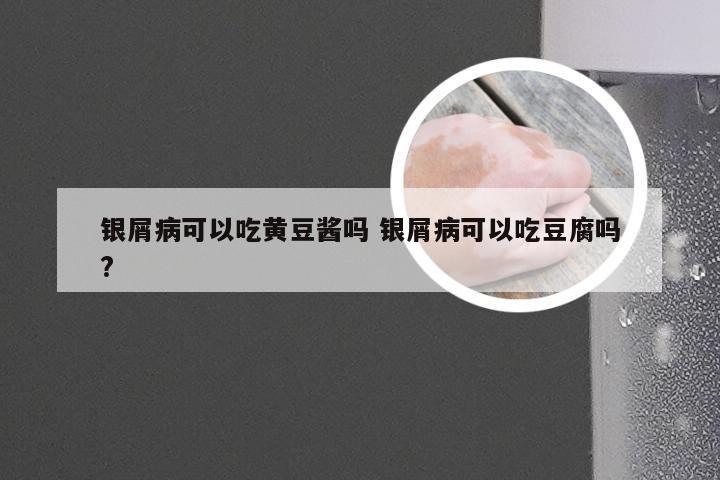 银屑病可以吃黄豆酱吗 银屑病可以吃豆腐吗?