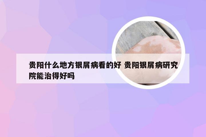 贵阳什么地方银屑病看的好 贵阳银屑病研究院能治得好吗