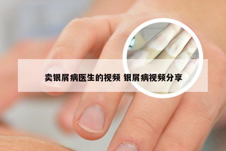 卖银屑病医生的视频 银屑病视频分享