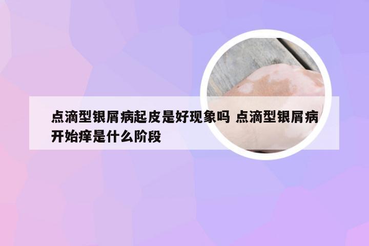 点滴型银屑病起皮是好现象吗 点滴型银屑病开始痒是什么阶段