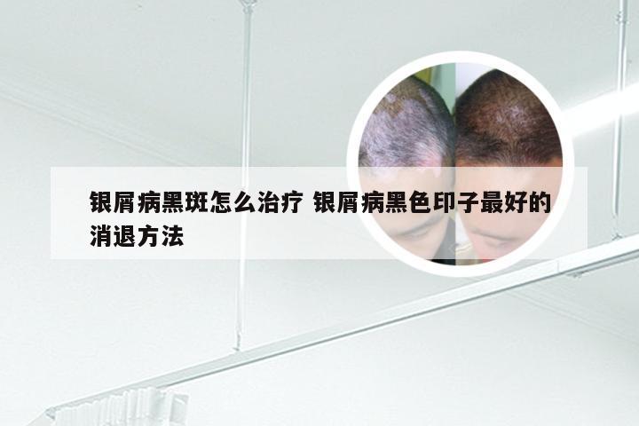 银屑病黑斑怎么治疗 银屑病黑色印子最好的消退方法