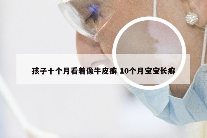 孩子十个月看着像牛皮癣 10个月宝宝长癣