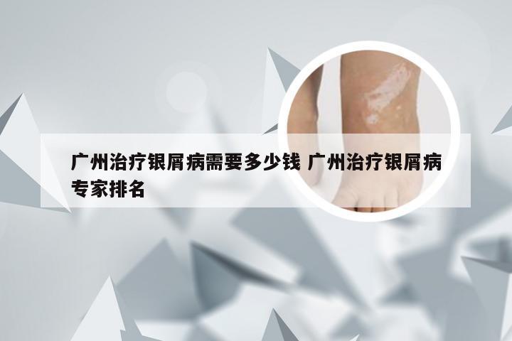 广州治疗银屑病需要多少钱 广州治疗银屑病专家排名