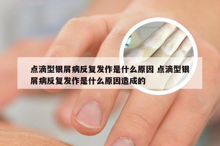 点滴型银屑病反复发作是什么原因 点滴型银屑病反复发作是什么原因造成的