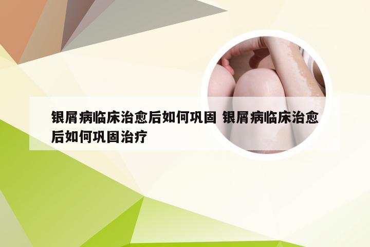 银屑病临床治愈后如何巩固 银屑病临床治愈后如何巩固治疗