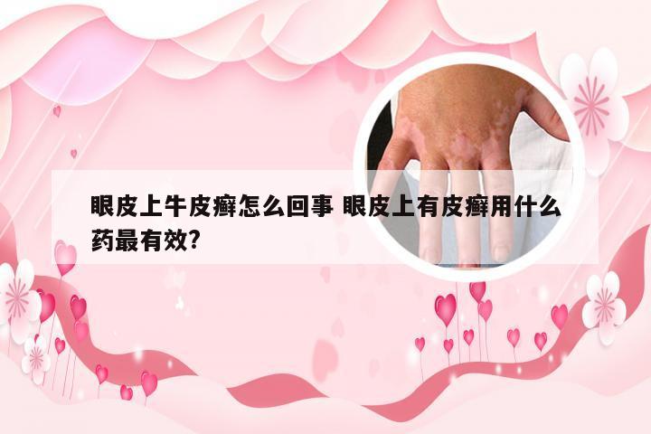 眼皮上牛皮癣怎么回事 眼皮上有皮癣用什么药最有效?