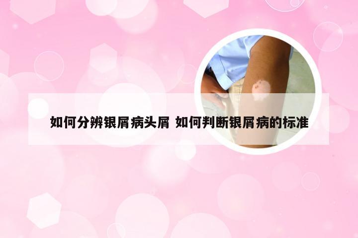 如何分辨银屑病头屑 如何判断银屑病的标准